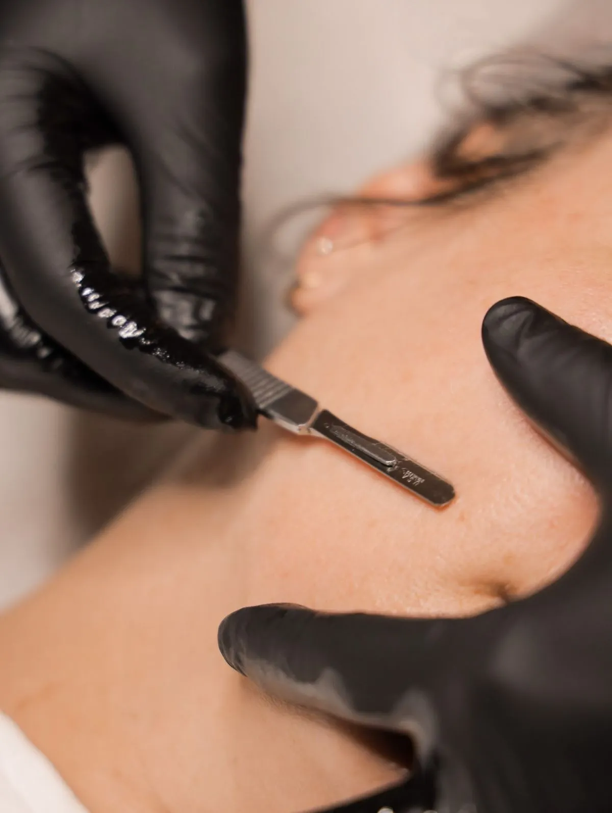 What Is Dermaplaning?